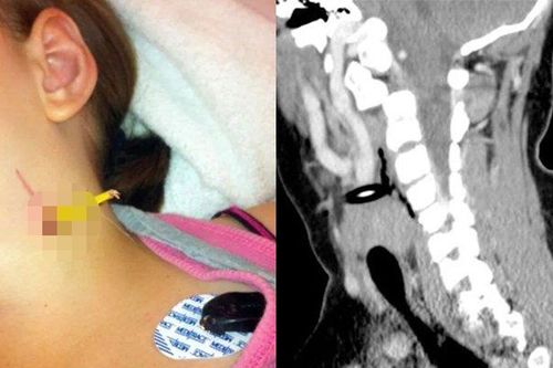 Ngã tại trường, bé 11 tuổi bị bút chì đâm ngang cổ phải nhập viện khẩn cấp