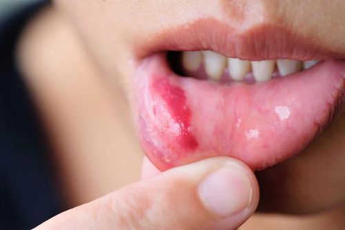 Ung thư lưỡi đang có xu hướng trẻ hóa