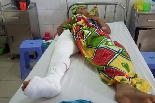 Cán bộ địa chính bị xe của 'cát tặc' tông gãy chân