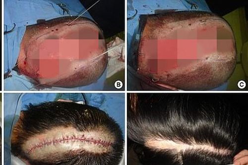 Kinh hoàng cô gái Hàn bị tróc da đầu chỉ vì nhuộm tóc