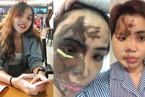 'Bố mẹ phải giấu tất cả gương soi vì sợ tôi nghĩ quẩn'