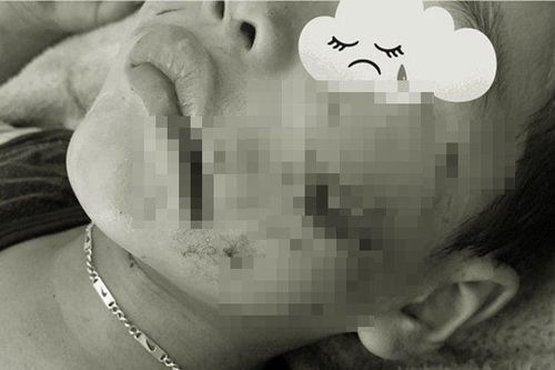 Chó nhà nuôi chưa tiêm phòng dại cắn nát mặt bé trai 5 tuổi ở Sơn La