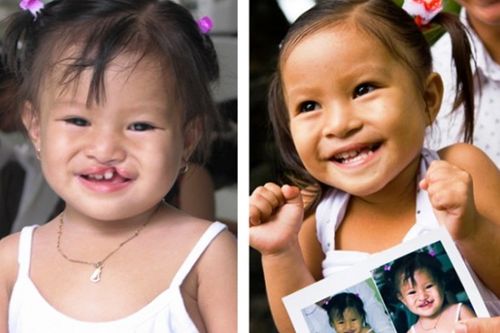 Phẫu thuật dị tật miễn phí mang lại nụ cười cho trẻ sứt môi, hở hàm ếch