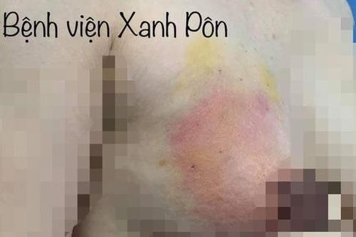 Thông cơ tạo má baby và làm đầy ngực đang gây sốt trên mạng: Đắng lòng bi kịch và lời cảnh tỉnh của chuyên gia