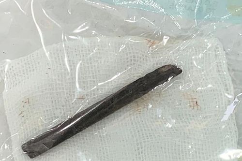 Khúc đũa 7 cm bị 'bỏ quên' trong hốc mũi bệnh nhân suốt 4 năm