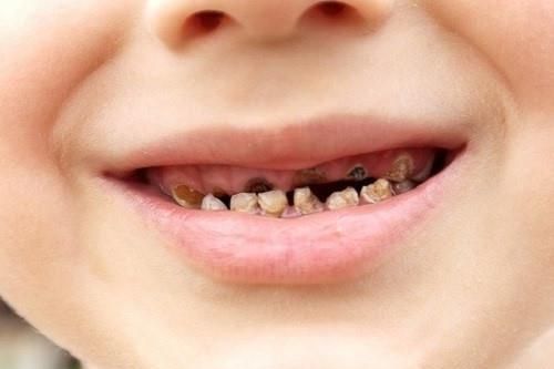 Sâu răng không chữa, bé 3 tuổi suýt mù