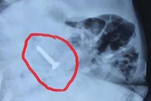 Bé 20 tháng tuổi nuốt chiếc đinh vít sắc nhọn dài đến 3,5 cm