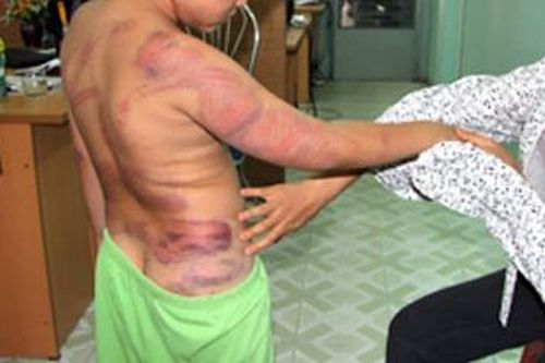 Bé trai 6 tuổi nghi bị mẹ ruột bạo hành dã man