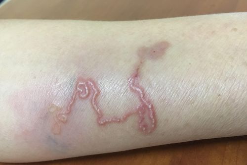 Kinh hoàng ấu trùng giun chó mèo 'đào hầm' dưới da