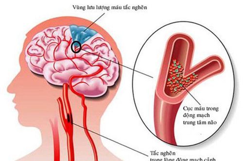 Nắng nóng 41 độ, cảnh báo 7 dấu hiệu sớm của đột quỵ, giúp bạn thoát chết trong gang tấc