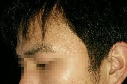 Cơ thể biến dạng vì căn bệnh tự dị ứng nguy hiểm