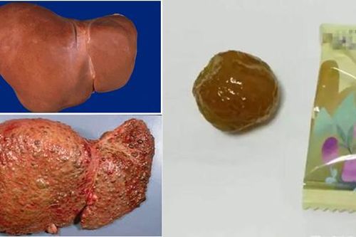 Giảm cân bằng cách ăn hoa quả sấy, người phụ nữ nhập viện vì xơ gan