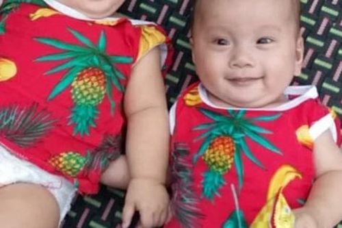 Rớt nước mắt hoàn cảnh bé sinh đôi mắc bệnh tim phức tạp cần phẫu thuật gấp