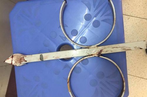 Phẫu thuật lấy cọc sắt ra khỏi cẳng tay một nạn nhân