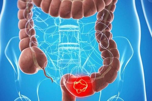 Tránh ung thư đại tràng bằng việc điều chỉnh thói quen