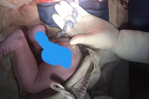 Cứu sống bé trai có nút thắt đôi ở dây rốn