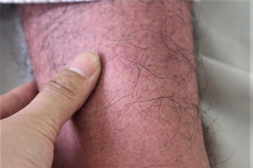 Dịch sốt xuất huyết vào mùa, TP.HCM có 5 ca tử vong vì bệnh