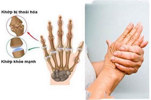 Thoái hóa khớp bàn tay ở người cao tuổi