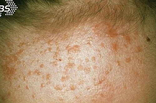 Cô gái bị nổi mụn cóc đầy ở trán chỉ vì dùng chung một vài vật dụng với chị gái: Khuyến cáo chị em đừng bao giờ làm theo