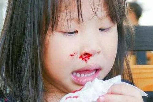 Từ vụ cháu bé nhập viện vì chảy máu cam ngày nắng nóng, cảnh báo điều cha mẹ cần làm để không hại con
