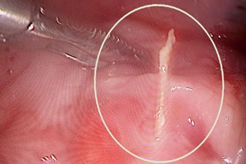 Que xiên thức ăn đâm thủng ruột bé trai 9 tuổi