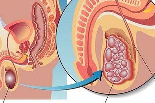 Dấu hiệu cảnh báo căn bệnh ung thư mà quý ông sợ nhất