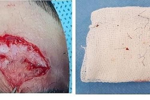 Cô gái trẻ loét giác mạc, suýt mù mắt vì nhấn mí thẩm mỹ tại spa