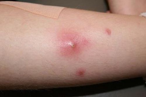 Mẹ tự ý nặn nhọt khiến con phải nhập viện cấp cứu