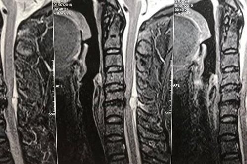 Sau giác hơi, một bệnh nhân suýt phải ngồi xe lăn suốt đời