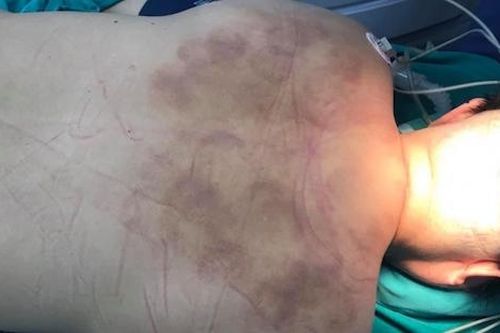 Người phụ nữ đột ngột liệt nửa người sau khi giác hơi, bấm huyệt