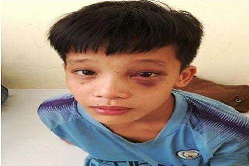 Nghịch súng tự chế, bé trai bị đinh kim loại ghim vào hốc mắt