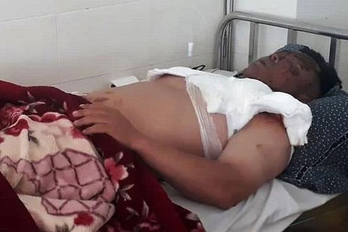 Bị hất nguyên nồi lẩu đang sôi vào mặt khi dự đám cưới