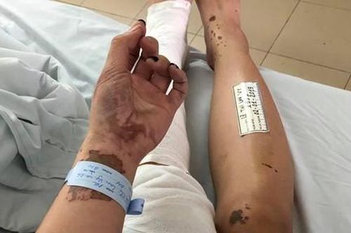 Dùng axit hủy hoại gương mặt vợ sắp cưới chỉ vì tin nhắn điện thoại