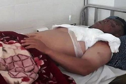Bị hất cả nồi lẩu đang sôi vào mặt vì hỏi tuổi phụ huynh