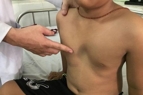 Trẻ bị viêm phổi kéo dài, cẩn trọng mắc lõm ngực bẩm sinh
