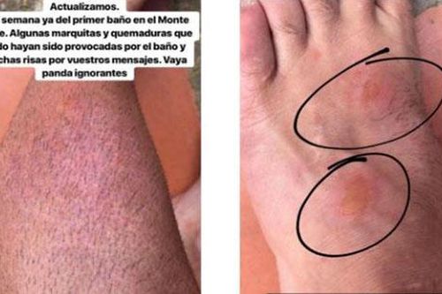 Nam thanh niên nhập viện sau khi bơi tại hồ Monte Neme nổi tiếng Tây Ban Nha