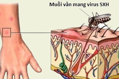 Bộ Y tế yêu cầu bảo đảm cung ứng thuốc phòng, điều trị sốt xuất huyết