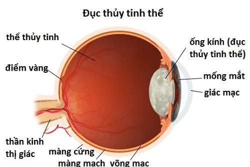 Mắt nhìn mờ do đục thủy tinh thể