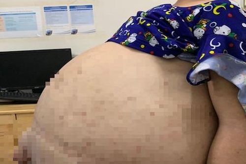 Hút 40 lít nước trong bụng cứu cô gái mang bệnh chỉ 10 người mắc trên thế giới