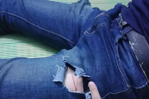 Nam sinh Sài Gòn bị côn đồ dùng dao lam rạch chân cướp tài sản