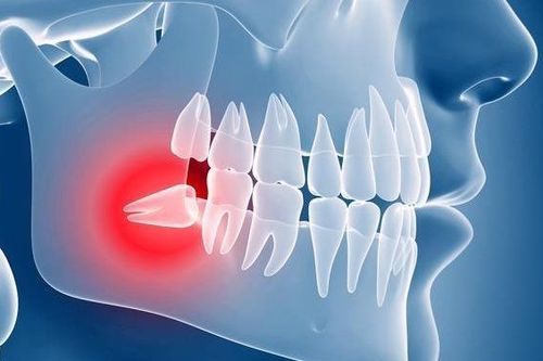 Vừa chiến thắng ung thư, người phụ nữ tử vong vì nhổ răng khôn