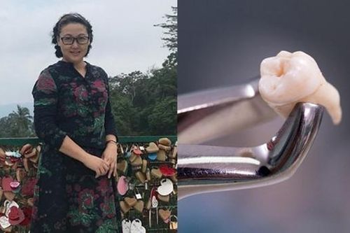 Người phụ nữ vừa chữa khỏi ung thư nhưng lại qua đời vì nhổ răng khôn