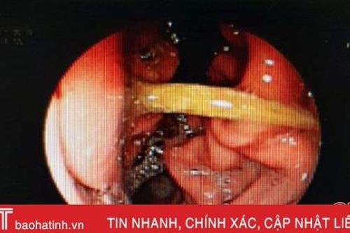 Ngậm tăm lúc ngủ, người đàn ông 60 tuổi ở Hà Tĩnh bị thủng dạ dày