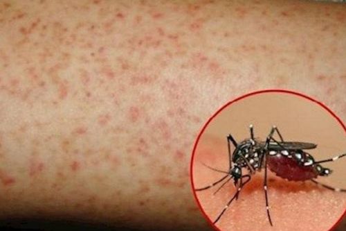 Bao giờ vắc-xin sốt xuất huyết được cấp phép lưu hành tại Việt Nam?