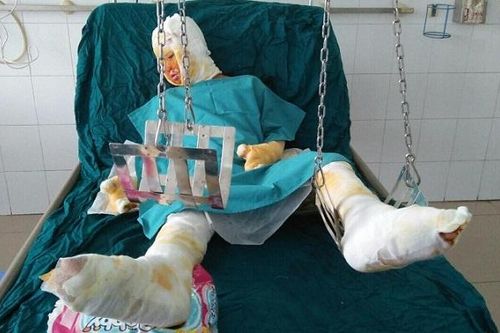 Xin cứu bé gái còn sống trong vụ tẩm xăng đốt cả gia đình ở Sơn La
