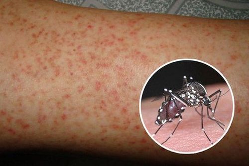 Đắk Lắk: Bé gái 15 tuổi tử vong do sốt xuất huyết
