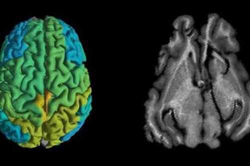 Kỹ thuật MRI mới giúp sớm phát hiện các căn bệnh thoái hóa thần kinh
