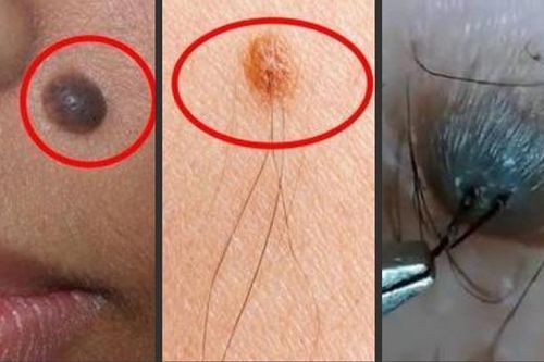 Nốt ruồi nào sẽ có nguy cơ gây ung thư da?