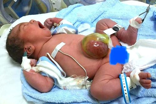 Sự phục hồi ngoạn mục của bé sơ sinh bị thoát vị rốn khổng lồ
