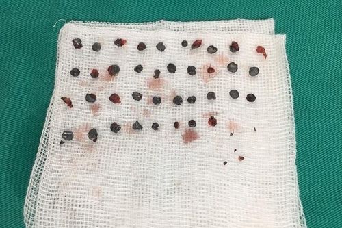Lấy 39 viên đạn hoa cải trên mặt người bệnh